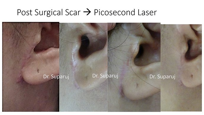 ดูแลรอยแผลผ่าตัด Surgical Scar เพื่อป้องกันการเกิดแผลเป็นนูนเกิน Hyperthrophic Scar และคีลอยด์ Keloid ดูแลรอยแผลผ่าตัด Surgical Scar เพื่อป้องกันการเกิดแผลเป็นนูนเกิน Hyperthrophic Scar และคีลอยด์ Keloid