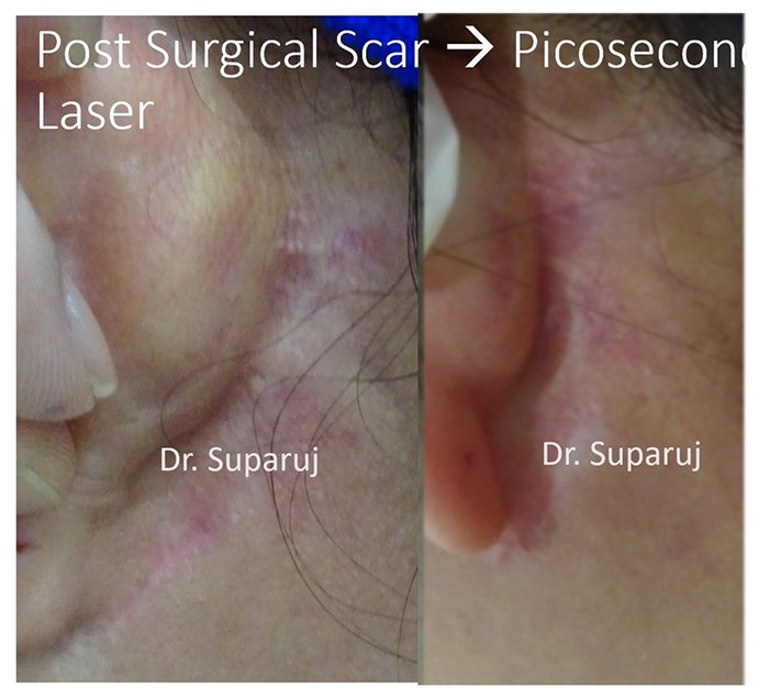 ดูแลรอยแผลผ่าตัด Surgical Scar เพื่อป้องกันการเกิดแผลเป็นนูนเกิน Hyperthrophic Scar และคีลอยด์ Keloid ดูแลรอยแผลผ่าตัด Surgical Scar เพื่อป้องกันการเกิดแผลเป็นนูนเกิน Hyperthrophic Scar และคีลอยด์ Keloid