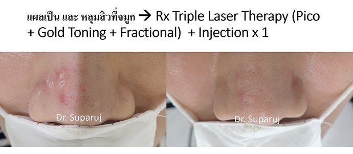 ดูแลรอยแผลผ่าตัด Surgical Scar เพื่อป้องกันการเกิดแผลเป็นนูนเกิน Hyperthrophic Scar และคีลอยด์ Keloid ดูแลรอยแผลผ่าตัด Surgical Scar เพื่อป้องกันการเกิดแผลเป็นนูนเกิน Hyperthrophic Scar และคีลอยด์ Keloid