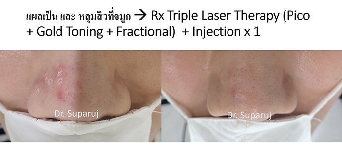 ดูแลรอยแผลผ่าตัด Surgical Scar เพื่อป้องกันการเกิดแผลเป็นนูนเกิน Hyperthrophic Scar และคีลอยด์ Keloid