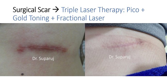 ดูแลรอยแผลผ่าตัด Surgical Scar เพื่อป้องกันการเกิดแผลเป็นนูนเกิน Hyperthrophic Scar และคีลอยด์ Keloid ดูแลรอยแผลผ่าตัด Surgical Scar เพื่อป้องกันการเกิดแผลเป็นนูนเกิน Hyperthrophic Scar และคีลอยด์ Keloid