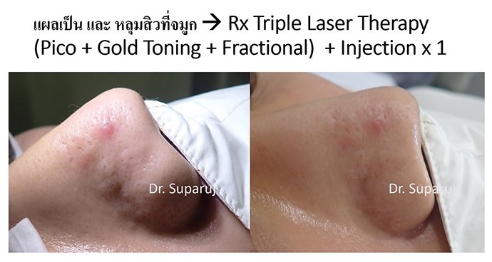 ดูแลรอยแผลผ่าตัด Surgical Scar เพื่อป้องกันการเกิดแผลเป็นนูนเกิน Hyperthrophic Scar และคีลอยด์ Keloid ดูแลรอยแผลผ่าตัด Surgical Scar เพื่อป้องกันการเกิดแผลเป็นนูนเกิน Hyperthrophic Scar และคีลอยด์ Keloid