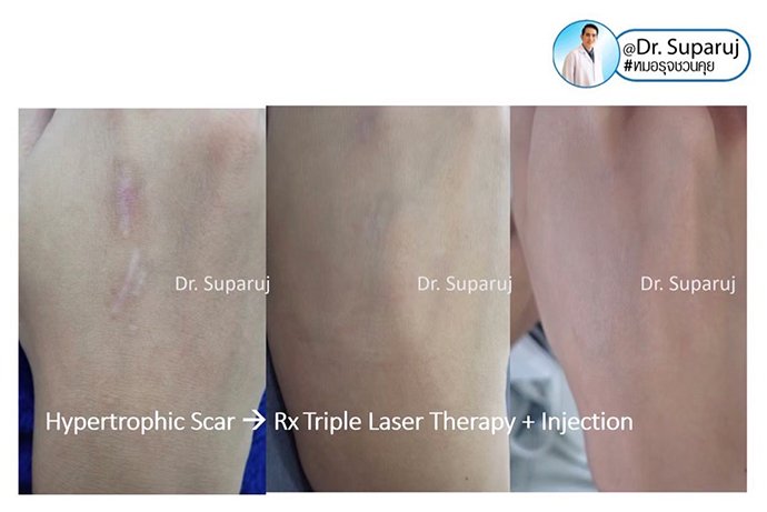ดูแลรอยแผลผ่าตัด Surgical Scar เพื่อป้องกันการเกิดแผลเป็นนูนเกิน Hyperthrophic Scar และคีลอยด์ Keloid ดูแลรอยแผลผ่าตัด Surgical Scar เพื่อป้องกันการเกิดแผลเป็นนูนเกิน Hyperthrophic Scar และคีลอยด์ Keloid