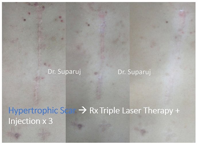 ดูแลรอยแผลผ่าตัด Surgical Scar เพื่อป้องกันการเกิดแผลเป็นนูนเกิน Hyperthrophic Scar และคีลอยด์ Keloid