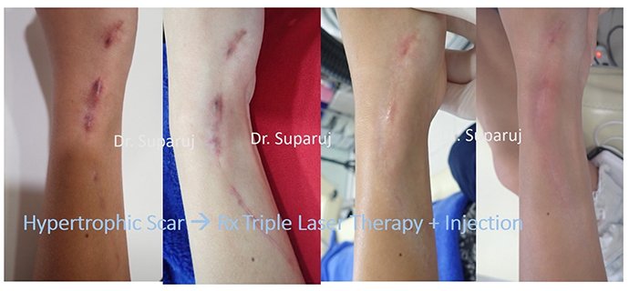 ดูแลรอยแผลผ่าตัด Surgical Scar เพื่อป้องกันการเกิดแผลเป็นนูนเกิน Hyperthrophic Scar และคีลอยด์ Keloid ดูแลรอยแผลผ่าตัด Surgical Scar เพื่อป้องกันการเกิดแผลเป็นนูนเกิน Hyperthrophic Scar และคีลอยด์ Keloid