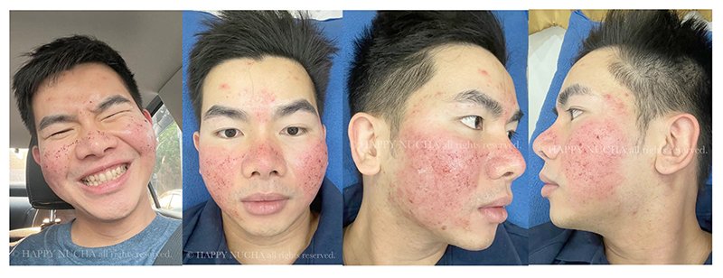 ขอบคุณน้องนุชาที่ให้ความไว้วางใจหมอรุจ ดูแลหลุมสิวให้มาตลอดครับ ขอบคุณน้องนุชาที่ให้ความไว้วางใจหมอรุจ ดูแลหลุมสิวให้มาตลอดครับ