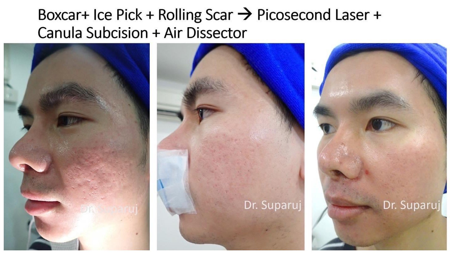 ขอบคุณน้องนุชาที่ให้ความไว้วางใจหมอรุจ ดูแลหลุมสิวให้มาตลอดครับ ขอบคุณน้องนุชาที่ให้ความไว้วางใจหมอรุจ ดูแลหลุมสิวให้มาตลอดครับ