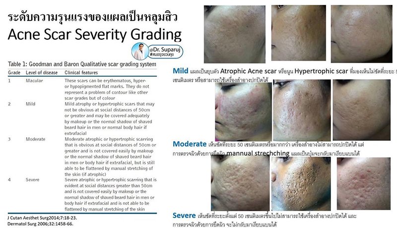 ขอบคุณน้องนุชาที่ให้ความไว้วางใจหมอรุจ ดูแลหลุมสิวให้มาตลอดครับ ขอบคุณน้องนุชาที่ให้ความไว้วางใจหมอรุจ ดูแลหลุมสิวให้มาตลอดครับ