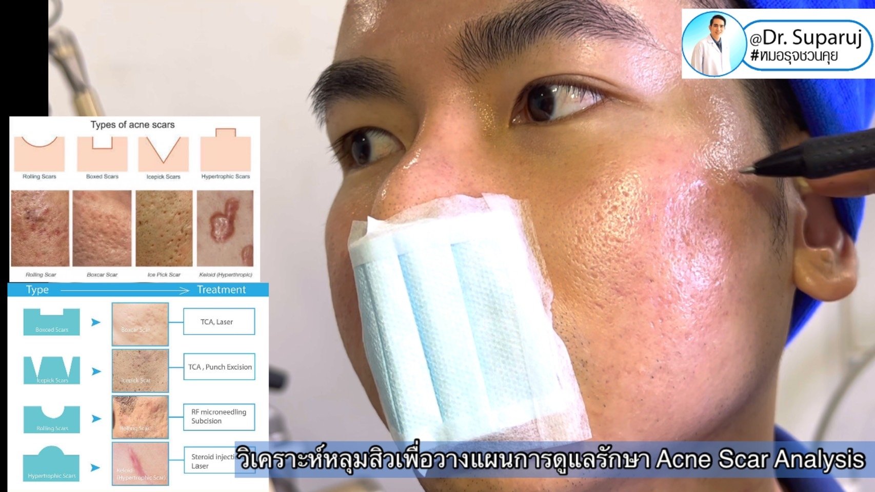 แนะนำเทคนิคดูแลหลุมสิว Ep. 19: วิเคราะห์ชนิดหลุมสิวเพื่อวางแผนการรักษา Acne Scar Analysis แนะนำเทคนิคดูแลหลุมสิว Ep. 19: วิเคราะห์ชนิดหลุมสิวเพื่อวางแผนการรักษา Acne Scar Analysis