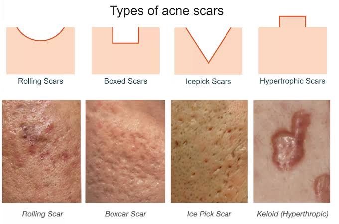 แนะนำเทคนิคดูแลหลุมสิว Ep. 19: วิเคราะห์ชนิดหลุมสิวเพื่อวางแผนการรักษา Acne Scar Analysis แนะนำเทคนิคดูแลหลุมสิว Ep. 19: วิเคราะห์ชนิดหลุมสิวเพื่อวางแผนการรักษา Acne Scar Analysis