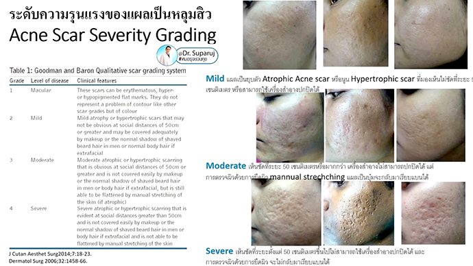 แนะนำเทคนิคดูแลหลุมสิว Ep. 19: วิเคราะห์ชนิดหลุมสิวเพื่อวางแผนการรักษา Acne Scar Analysis