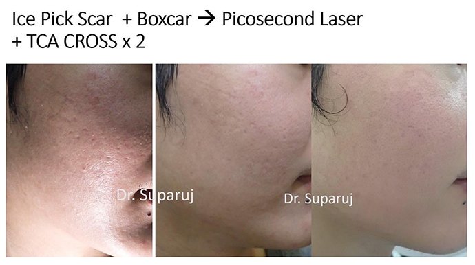 แนะนำเทคนิคดูแลหลุมสิว Ep. 19: วิเคราะห์ชนิดหลุมสิวเพื่อวางแผนการรักษา Acne Scar Analysis แนะนำเทคนิคดูแลหลุมสิว Ep. 19: วิเคราะห์ชนิดหลุมสิวเพื่อวางแผนการรักษา Acne Scar Analysis