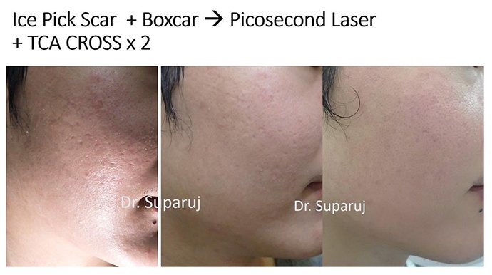 แนะนำเทคนิคดูแลหลุมสิว Ep. 19: วิเคราะห์ชนิดหลุมสิวเพื่อวางแผนการรักษา Acne Scar Analysis