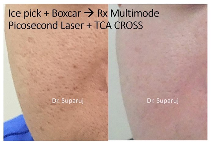 แนะนำเทคนิคดูแลหลุมสิว Ep. 19: วิเคราะห์ชนิดหลุมสิวเพื่อวางแผนการรักษา Acne Scar Analysis แนะนำเทคนิคดูแลหลุมสิว Ep. 19: วิเคราะห์ชนิดหลุมสิวเพื่อวางแผนการรักษา Acne Scar Analysis