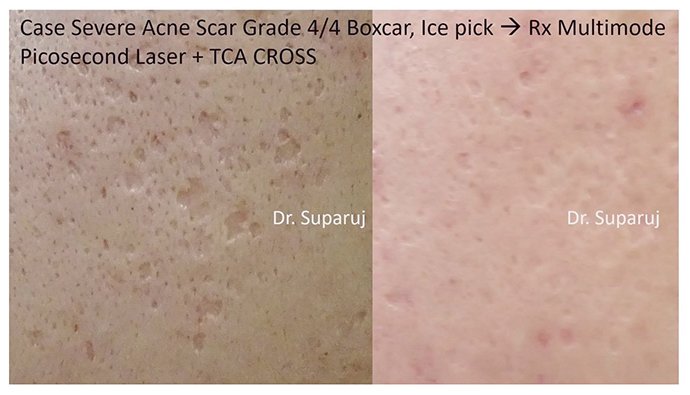 แนะนำเทคนิคดูแลหลุมสิว Ep. 19: วิเคราะห์ชนิดหลุมสิวเพื่อวางแผนการรักษา Acne Scar Analysis