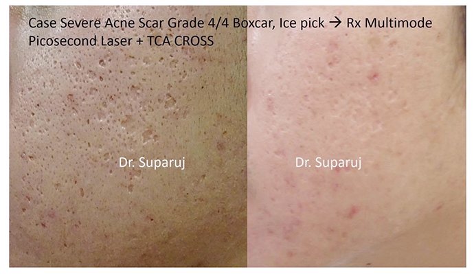 แนะนำเทคนิคดูแลหลุมสิว Ep. 19: วิเคราะห์ชนิดหลุมสิวเพื่อวางแผนการรักษา Acne Scar Analysis