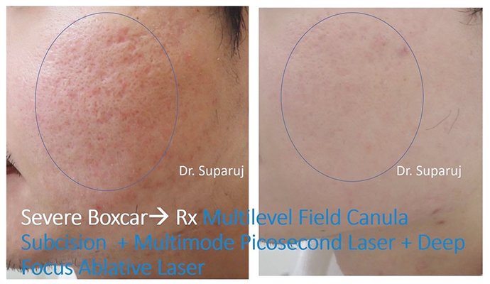 แนะนำเทคนิคดูแลหลุมสิว Ep. 19: วิเคราะห์ชนิดหลุมสิวเพื่อวางแผนการรักษา Acne Scar Analysis