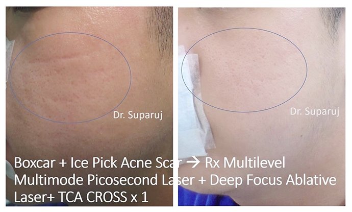 แนะนำเทคนิคดูแลหลุมสิว Ep. 19: วิเคราะห์ชนิดหลุมสิวเพื่อวางแผนการรักษา Acne Scar Analysis แนะนำเทคนิคดูแลหลุมสิว Ep. 19: วิเคราะห์ชนิดหลุมสิวเพื่อวางแผนการรักษา Acne Scar Analysis
