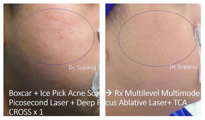 แนะนำเทคนิคดูแลหลุมสิว Ep. 19: วิเคราะห์ชนิดหลุมสิวเพื่อวางแผนการรักษา Acne Scar Analysis แนะนำเทคนิคดูแลหลุมสิว Ep. 19: วิเคราะห์ชนิดหลุมสิวเพื่อวางแผนการรักษา Acne Scar Analysis