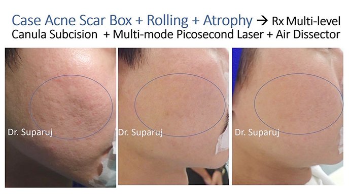 แนะนำเทคนิคดูแลหลุมสิว Ep. 19: วิเคราะห์ชนิดหลุมสิวเพื่อวางแผนการรักษา Acne Scar Analysis แนะนำเทคนิคดูแลหลุมสิว Ep. 19: วิเคราะห์ชนิดหลุมสิวเพื่อวางแผนการรักษา Acne Scar Analysis