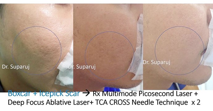 แนะนำเทคนิคดูแลหลุมสิว Ep. 19: วิเคราะห์ชนิดหลุมสิวเพื่อวางแผนการรักษา Acne Scar Analysis แนะนำเทคนิคดูแลหลุมสิว Ep. 19: วิเคราะห์ชนิดหลุมสิวเพื่อวางแผนการรักษา Acne Scar Analysis