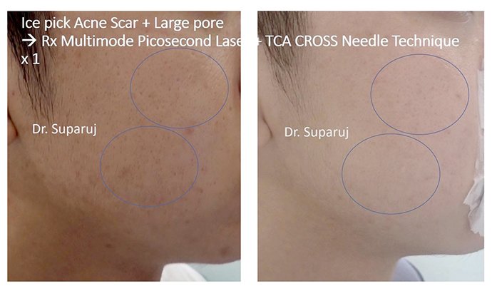 แนะนำเทคนิคดูแลหลุมสิว Ep. 19: วิเคราะห์ชนิดหลุมสิวเพื่อวางแผนการรักษา Acne Scar Analysis แนะนำเทคนิคดูแลหลุมสิว Ep. 19: วิเคราะห์ชนิดหลุมสิวเพื่อวางแผนการรักษา Acne Scar Analysis