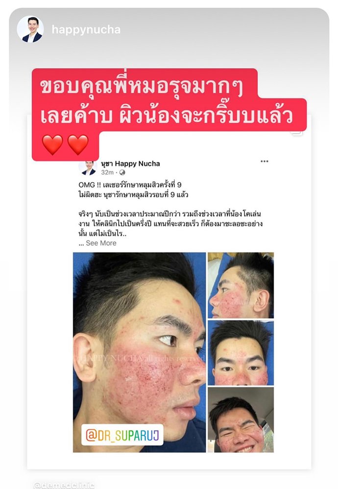 แนะนำเทคนิคดูแลหลุมสิว Ep. 19: วิเคราะห์ชนิดหลุมสิวเพื่อวางแผนการรักษา Acne Scar Analysis แนะนำเทคนิคดูแลหลุมสิว Ep. 19: วิเคราะห์ชนิดหลุมสิวเพื่อวางแผนการรักษา Acne Scar Analysis