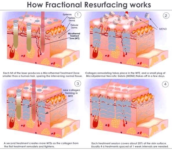 ดูแลหลุมสิวลึกด้วยเทคนิค Multi Direction Deep Focused Ablative Laser ดูแลหลุมสิวลึกด้วยเทคนิค Multi Direction Deep Focused Ablative Laser