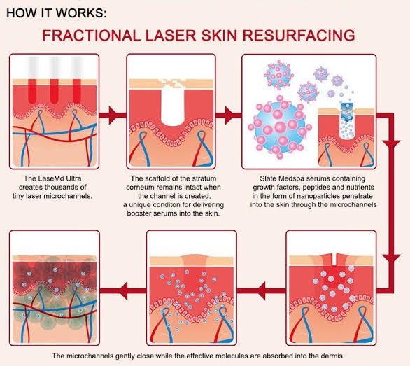 รักษาหลุมสิวด้วยเลเซอร์กรอผิวชนิดลอกทั้งช้ันผิว Full field vs ลอกแบบแบ่งส่วน Fractional Ablative Laser Resurfacing มีจุดเด่นและการใช้แตกต่างกันอย่างไร ? รักษาหลุมสิวด้วยเลเซอร์กรอผิวชนิดลอกทั้งช้ันผิว Full field vs ลอกแบบแบ่งส่วน Fractional Ablative Laser Resurfacing มีจุดเด่นและการใช้แตกต่างกันอย่างไร ?