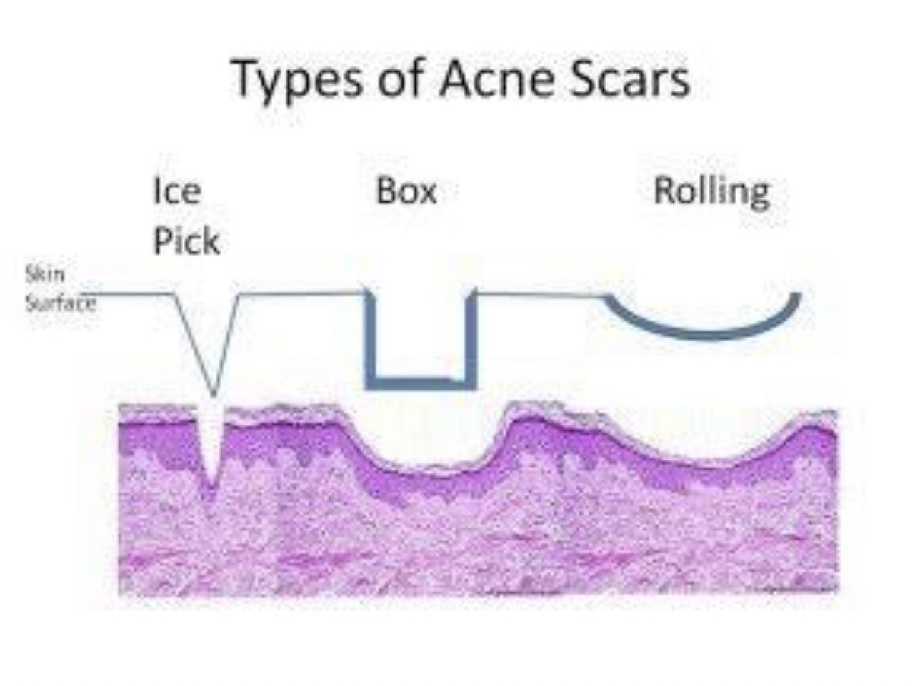 ดูแลหลุมสิวลึกด้วยเทคนิค Multi Direction Deep Focused Ablative Laser ดูแลหลุมสิวลึกด้วยเทคนิค Multi Direction Deep Focused Ablative Laser