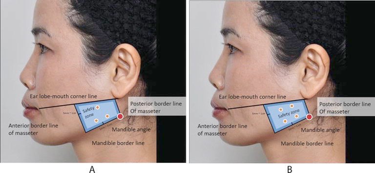 ฉีดBotulinum Toxinที่กล้ามเนื้อกราม Masseter muscleแล้วมีก้อนเวลากัดฟันเกิดจากอะไร แก้ไขได้อย่างไร? ฉีดBotulinum Toxinที่กล้ามเนื้อกราม Masseter muscleแล้วมีก้อนเวลากัดฟันเกิดจากอะไร แก้ไขได้อย่างไร?