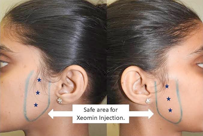 ฉีดBotulinum Toxinที่กล้ามเนื้อกราม Masseter muscleแล้วมีก้อนเวลากัดฟันเกิดจากอะไร แก้ไขได้อย่างไร? ฉีดBotulinum Toxinที่กล้ามเนื้อกราม Masseter muscleแล้วมีก้อนเวลากัดฟันเกิดจากอะไร แก้ไขได้อย่างไร?