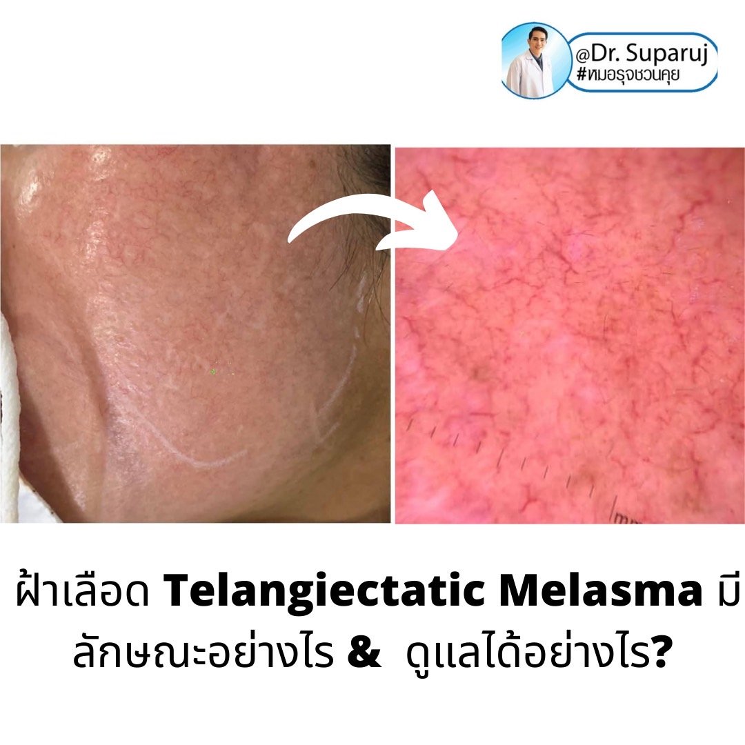 ฝ้าเลือด Telangiectatic Melasma มีลักษณะอย่างไร & ดูแลได้อย่างไร? ฝ้าเลือด Telangiectatic Melasma มีลักษณะอย่างไร & ดูแลได้อย่างไร?