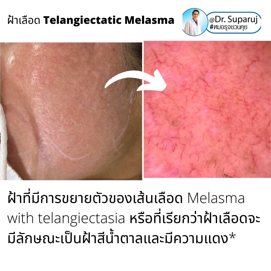 ฝ้าเลือด Telangiectatic Melasma มีลักษณะอย่างไร & ดูแลได้อย่างไร? ฝ้าเลือด Telangiectatic Melasma มีลักษณะอย่างไร & ดูแลได้อย่างไร?