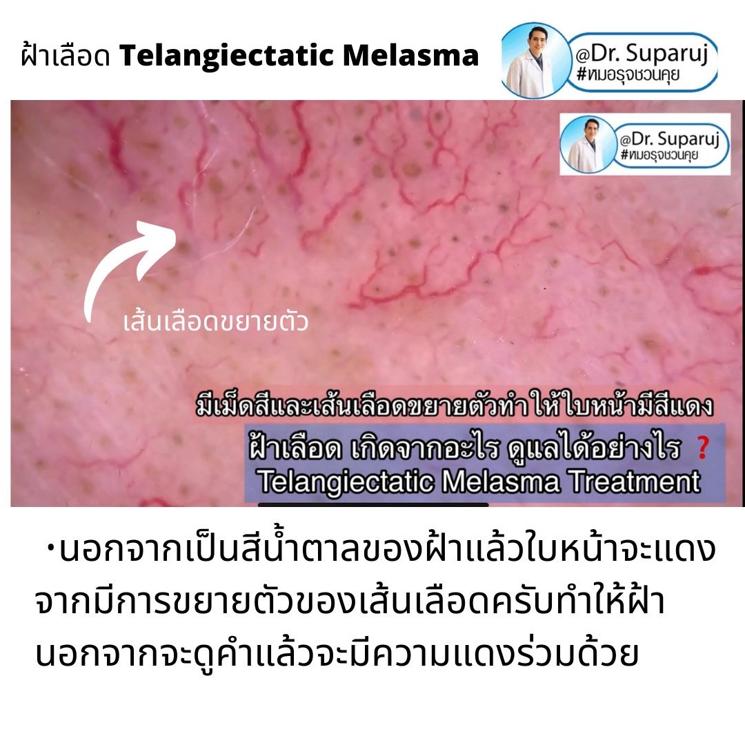 ฝ้าเลือด Telangiectatic Melasma มีลักษณะอย่างไร & ดูแลได้อย่างไร? ฝ้าเลือด Telangiectatic Melasma มีลักษณะอย่างไร & ดูแลได้อย่างไร?
