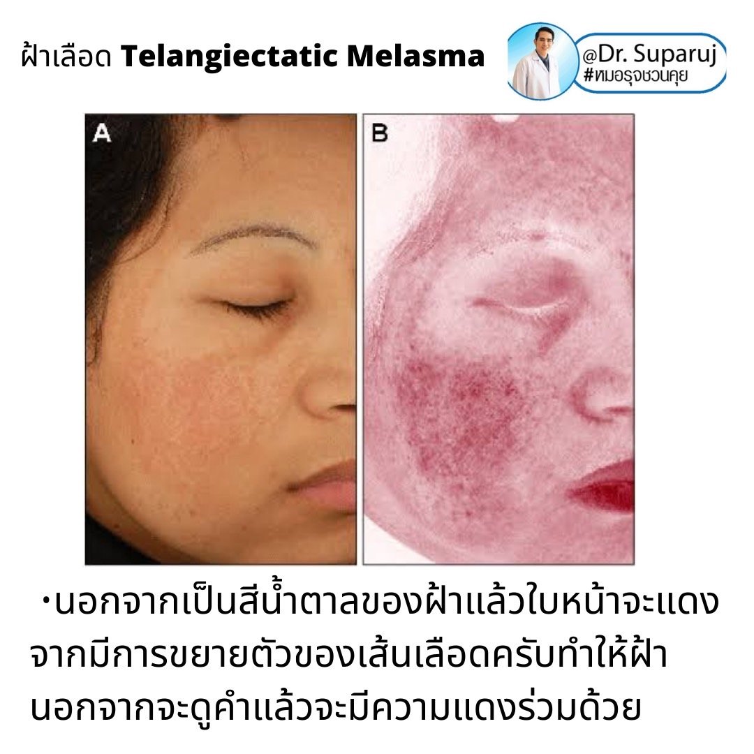 ฝ้าเลือด Telangiectatic Melasma มีลักษณะอย่างไร & ดูแลได้อย่างไร? ฝ้าเลือด Telangiectatic Melasma มีลักษณะอย่างไร & ดูแลได้อย่างไร?
