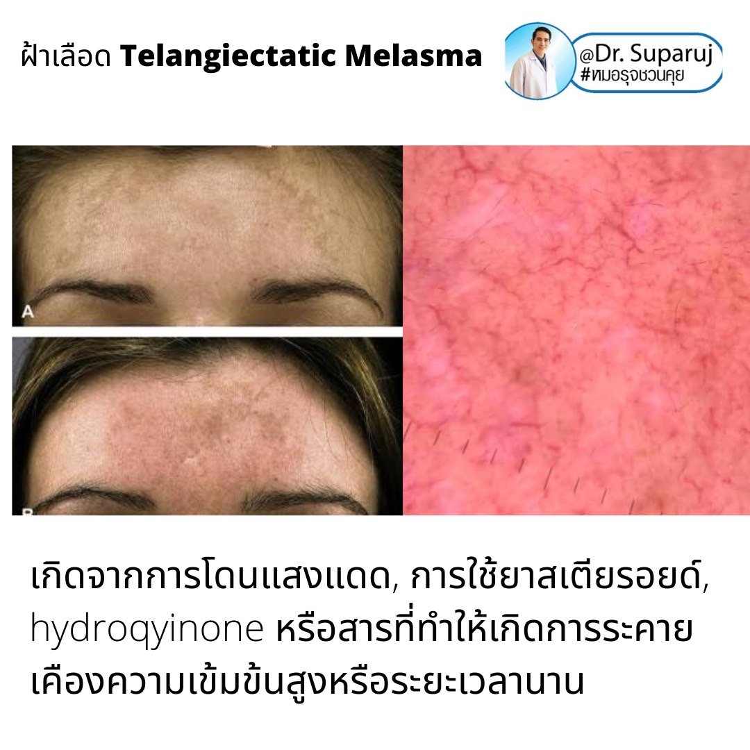 ฝ้าเลือด Telangiectatic Melasma มีลักษณะอย่างไร & ดูแลได้อย่างไร? ฝ้าเลือด Telangiectatic Melasma มีลักษณะอย่างไร & ดูแลได้อย่างไร?