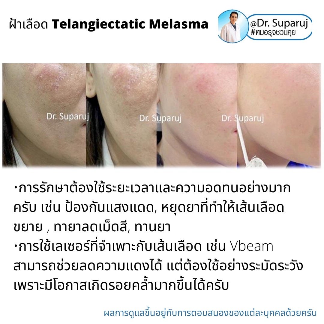 ฝ้าเลือด Telangiectatic Melasma มีลักษณะอย่างไร & ดูแลได้อย่างไร? ฝ้าเลือด Telangiectatic Melasma มีลักษณะอย่างไร & ดูแลได้อย่างไร?