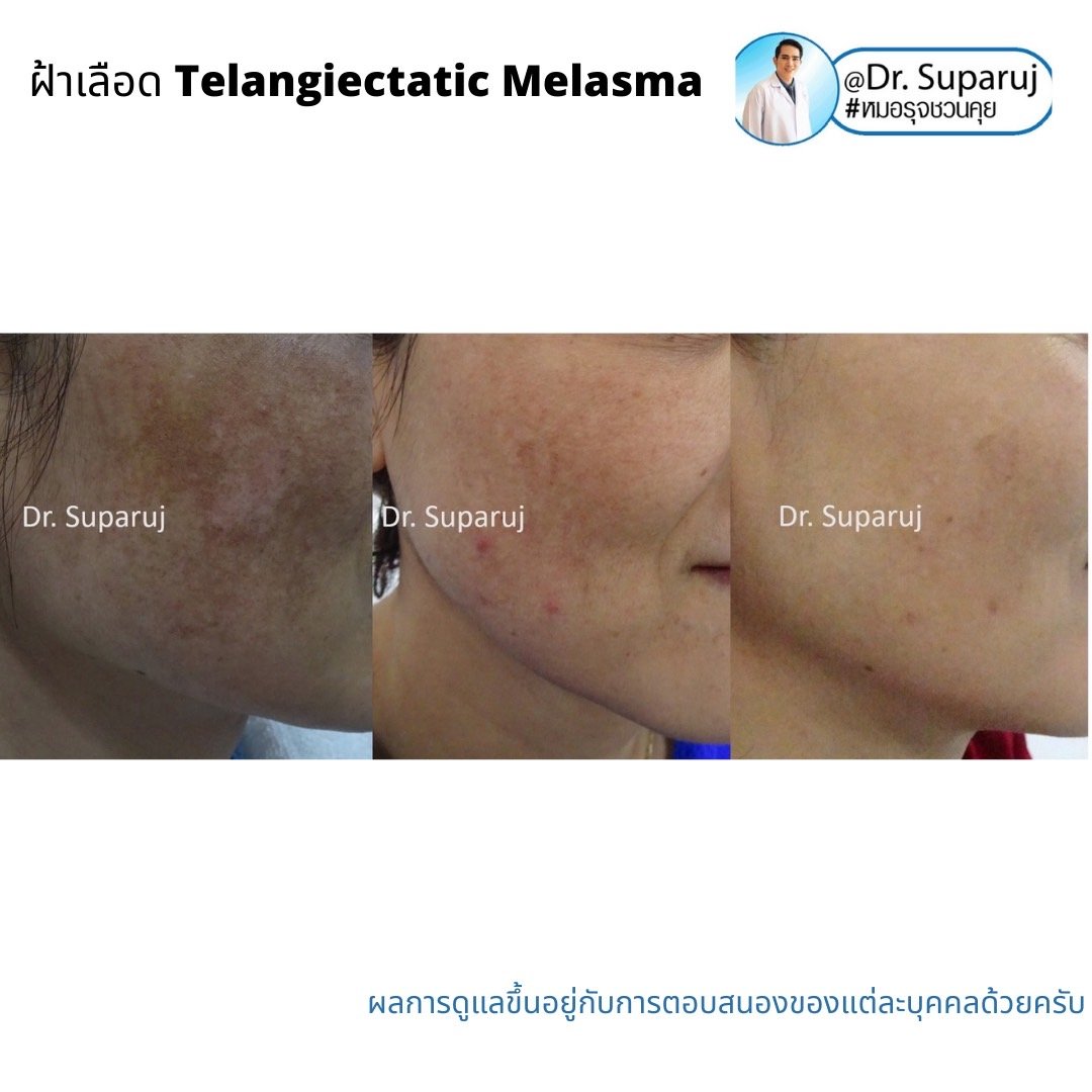 ฝ้าเลือด Telangiectatic Melasma มีลักษณะอย่างไร & ดูแลได้อย่างไร? ฝ้าเลือด Telangiectatic Melasma มีลักษณะอย่างไร & ดูแลได้อย่างไร?