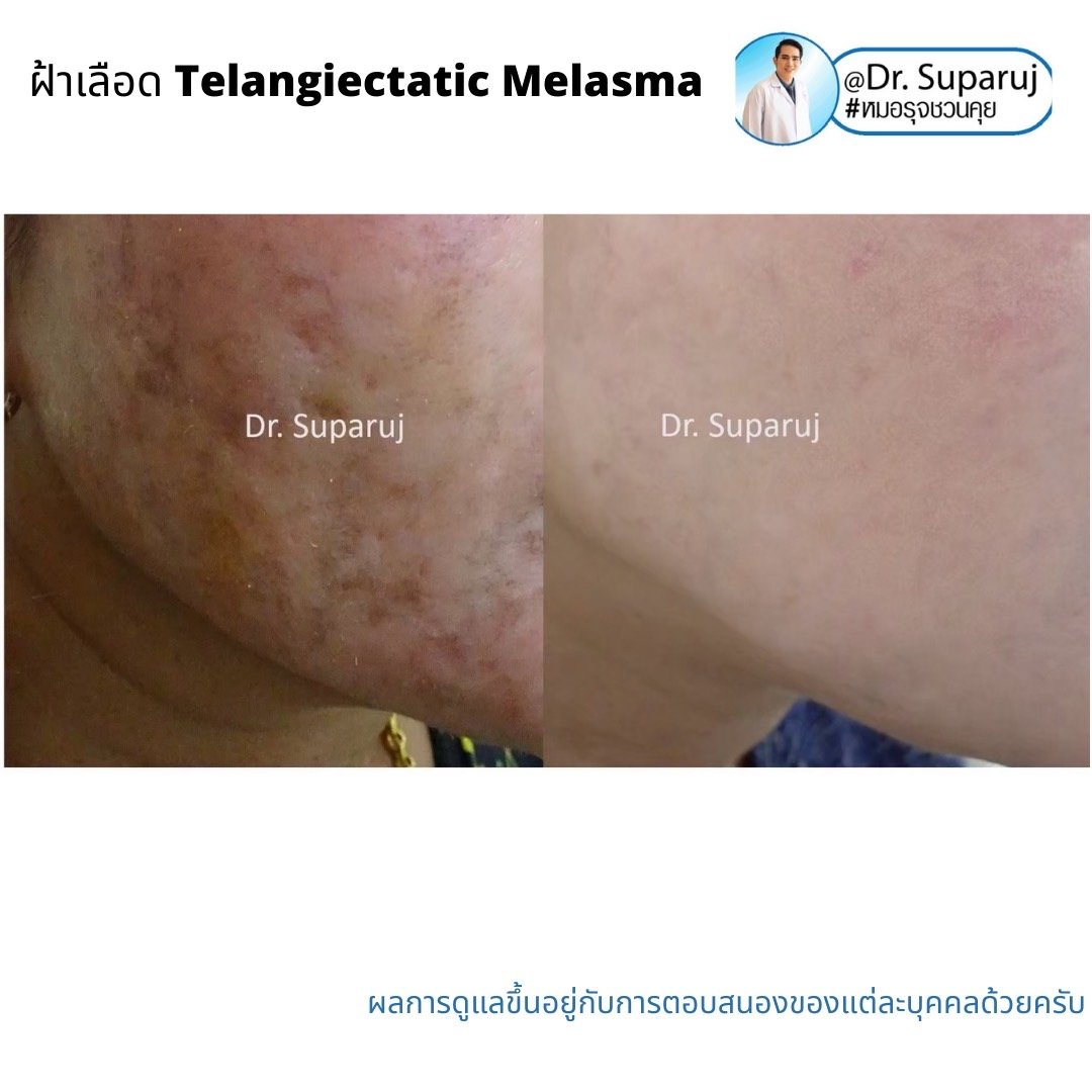 ฝ้าเลือด Telangiectatic Melasma มีลักษณะอย่างไร & ดูแลได้อย่างไร? ฝ้าเลือด Telangiectatic Melasma มีลักษณะอย่างไร & ดูแลได้อย่างไร?