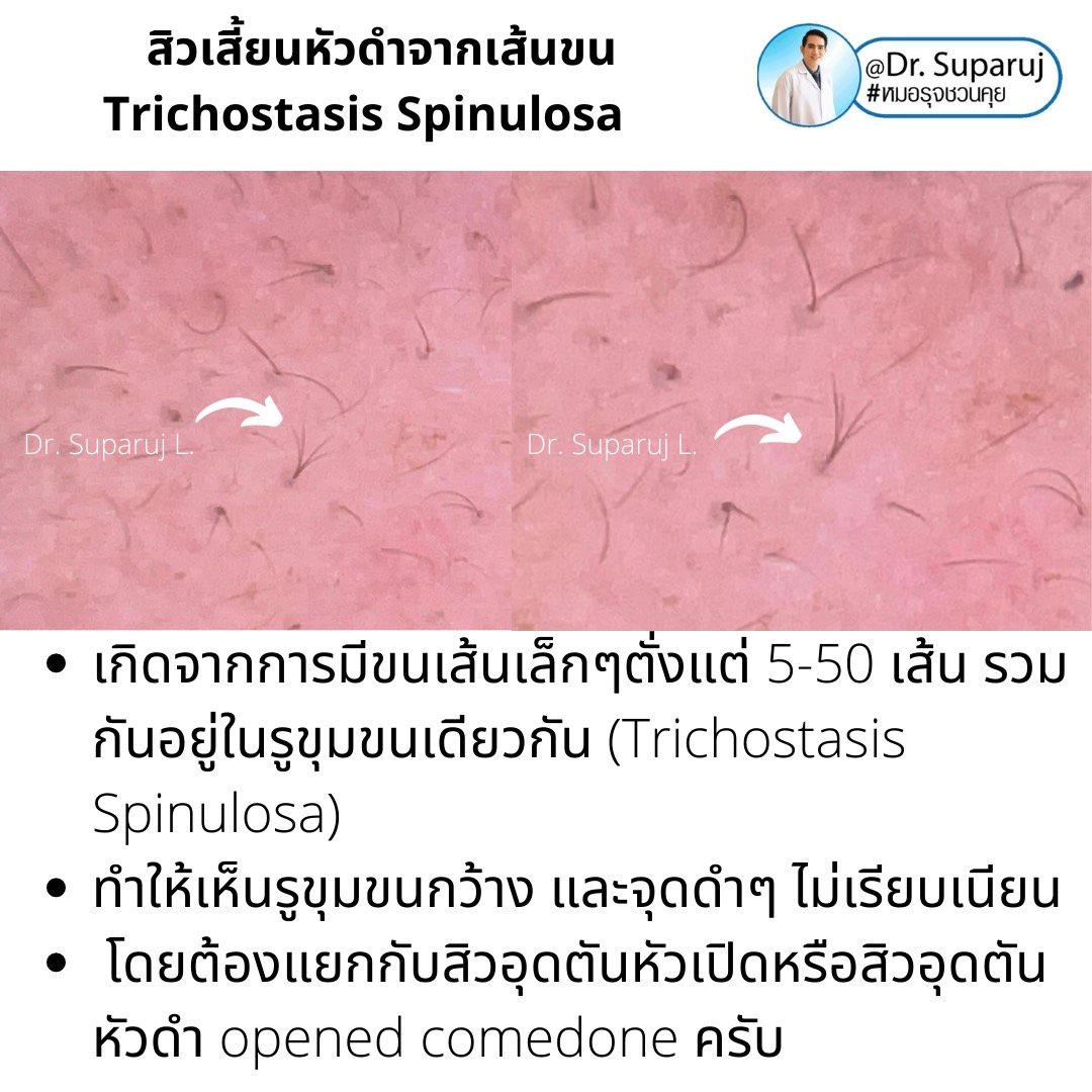 คล้ายสิว…แต่ไม่ใช่สิว… แต่เป็น…สิวเสี้ยนหัวดำจากเส้นขน Trichostasis Spinulosa? คล้ายสิว…แต่ไม่ใช่สิว… แต่เป็น…สิวเสี้ยนหัวดำจากเส้นขน Trichostasis Spinulosa?