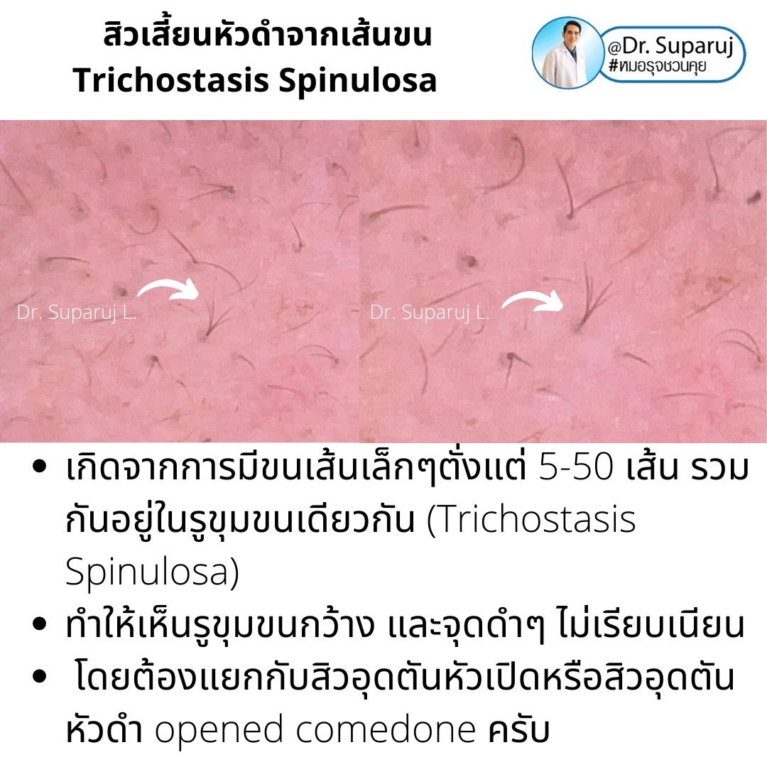 คล้ายสิว…แต่ไม่ใช่สิว… แต่เป็น…สิวเสี้ยนหัวดำจากเส้นขน Trichostasis Spinulosa?