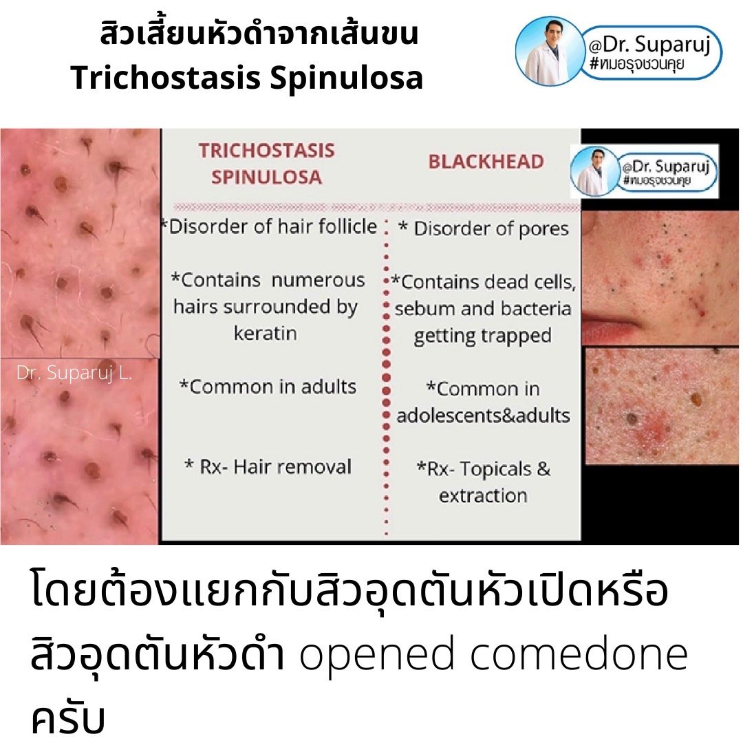 คล้ายสิว…แต่ไม่ใช่สิว… แต่เป็น…สิวเสี้ยนหัวดำจากเส้นขน Trichostasis Spinulosa? คล้ายสิว…แต่ไม่ใช่สิว… แต่เป็น…สิวเสี้ยนหัวดำจากเส้นขน Trichostasis Spinulosa?
