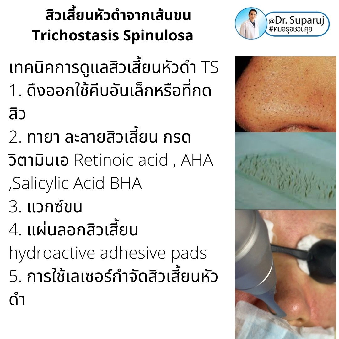 คล้ายสิว…แต่ไม่ใช่สิว… แต่เป็น…สิวเสี้ยนหัวดำจากเส้นขน Trichostasis Spinulosa?