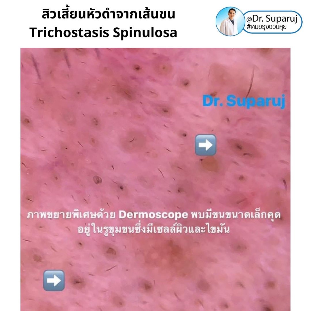 คล้ายสิว…แต่ไม่ใช่สิว… แต่เป็น…สิวเสี้ยนหัวดำจากเส้นขน Trichostasis Spinulosa? คล้ายสิว…แต่ไม่ใช่สิว… แต่เป็น…สิวเสี้ยนหัวดำจากเส้นขน Trichostasis Spinulosa?
