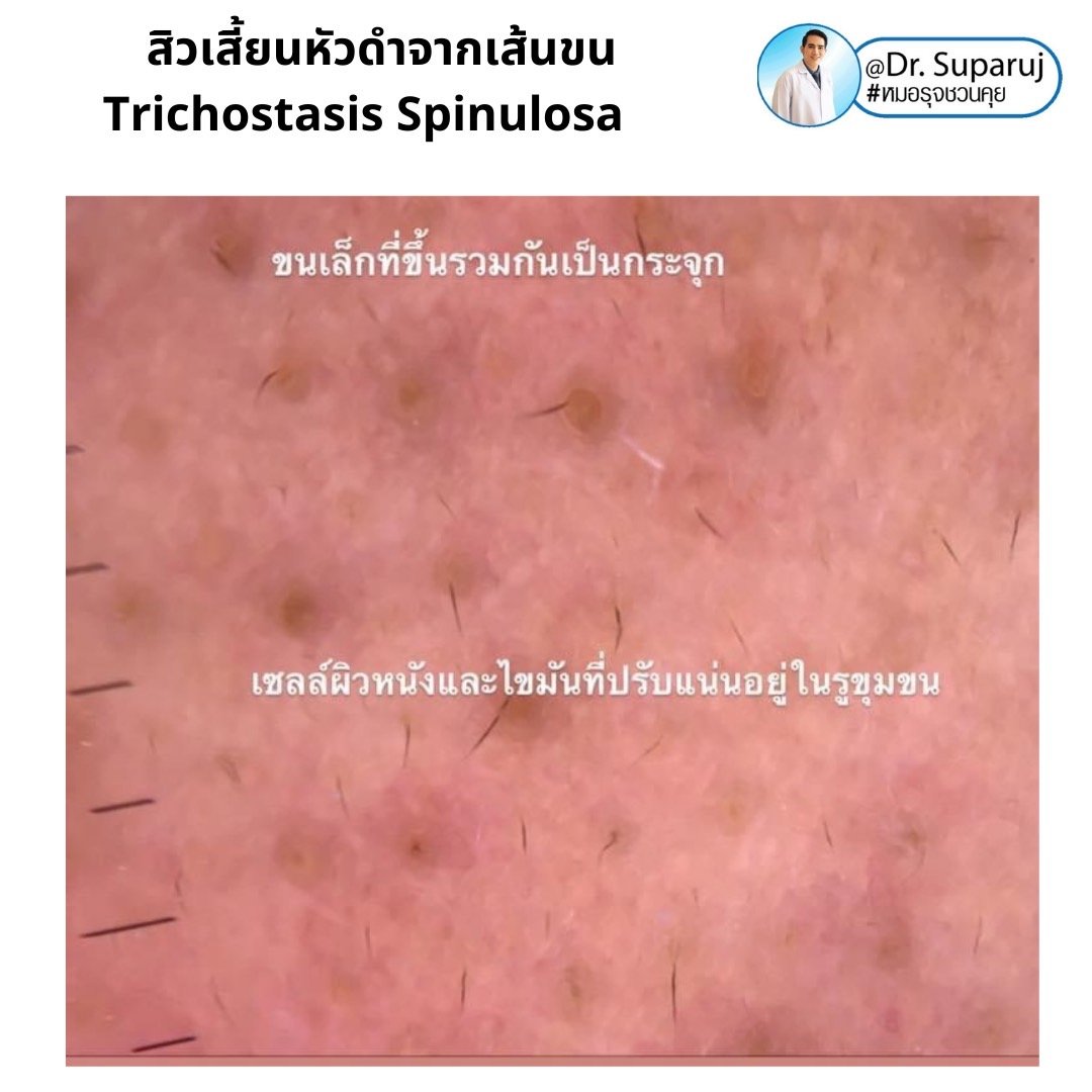 คล้ายสิว…แต่ไม่ใช่สิว… แต่เป็น…สิวเสี้ยนหัวดำจากเส้นขน Trichostasis Spinulosa? คล้ายสิว…แต่ไม่ใช่สิว… แต่เป็น…สิวเสี้ยนหัวดำจากเส้นขน Trichostasis Spinulosa?