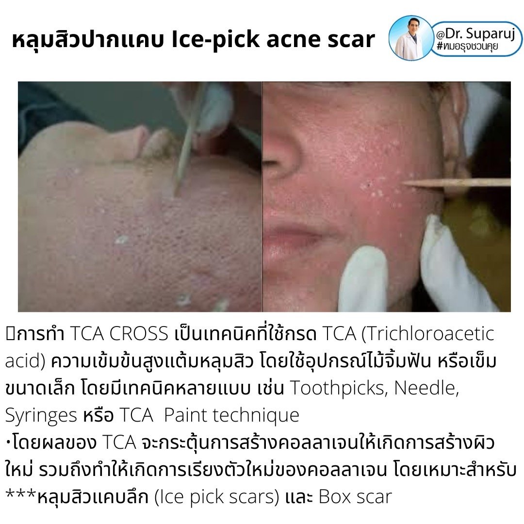 เทคนิครักษาหลุมสิวด้วยการแต้มกรด TCA บริเวณแผลเป็นหลุมสิว (TCA CROSS) เทคนิครักษาหลุมสิวด้วยการแต้มกรด TCA บริเวณแผลเป็นหลุมสิว (TCA CROSS)