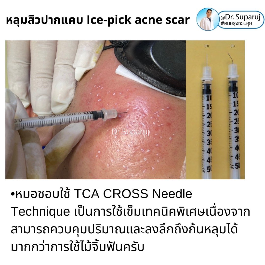 เทคนิครักษาหลุมสิวด้วยการแต้มกรด TCA บริเวณแผลเป็นหลุมสิว (TCA CROSS)