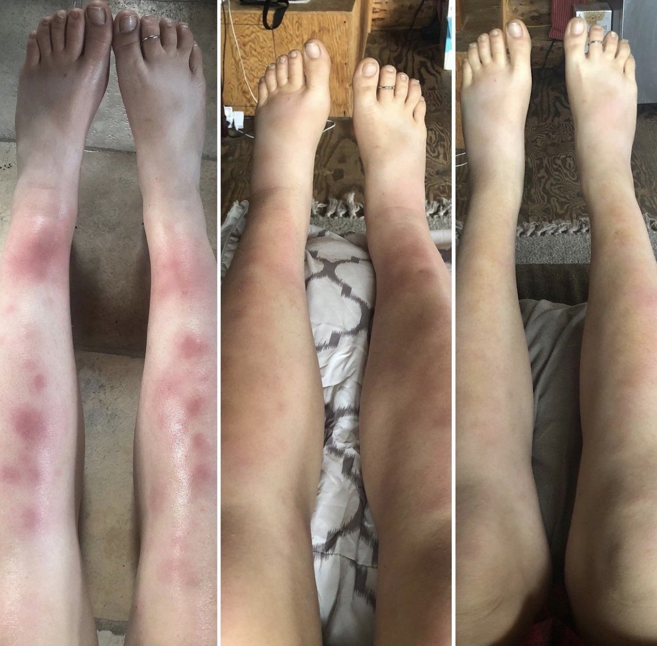 การอักเสบของชั้นไขมันใต้ผิวหนัง Erythema Nodosum คืออะไร ดูแลได้อย่างไร ?