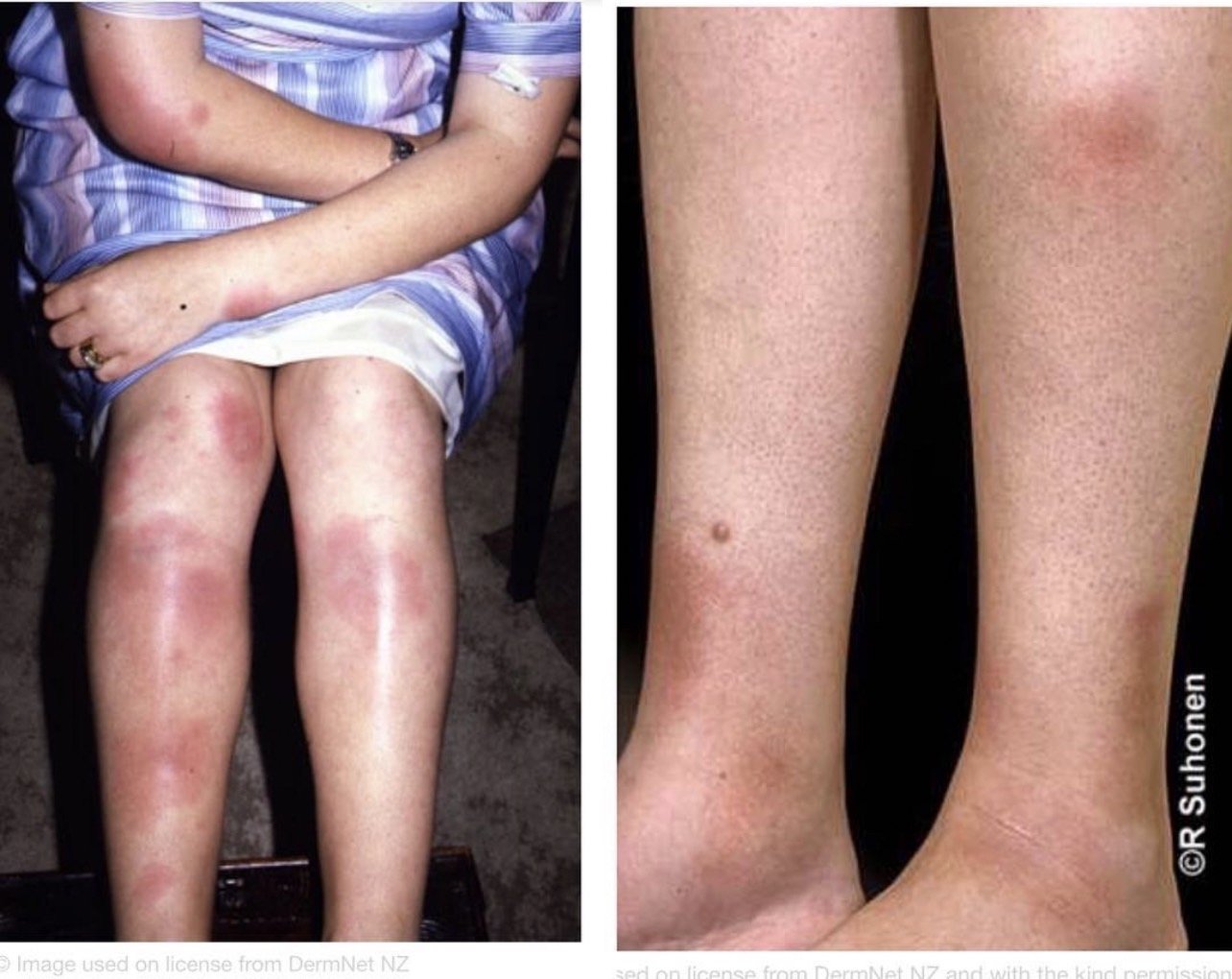 การอักเสบของชั้นไขมันใต้ผิวหนัง Erythema Nodosum คืออะไร ดูแลได้อย่างไร ?